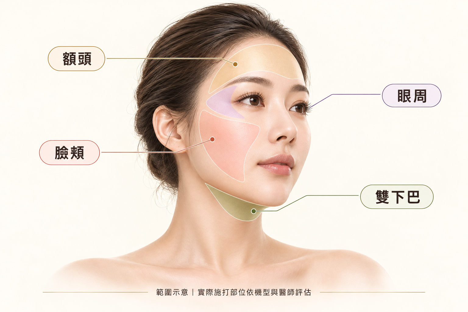 音波拉提臉部治療區域